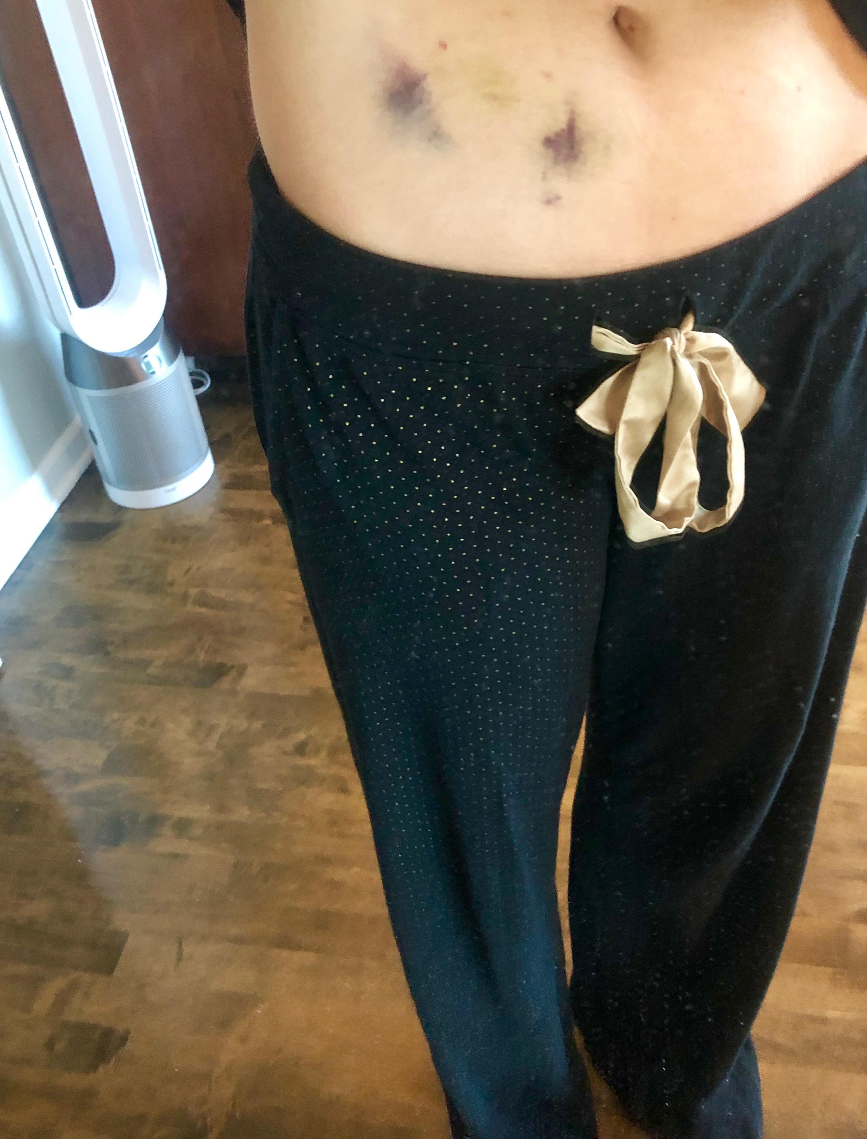 bruises from lovenox injections 