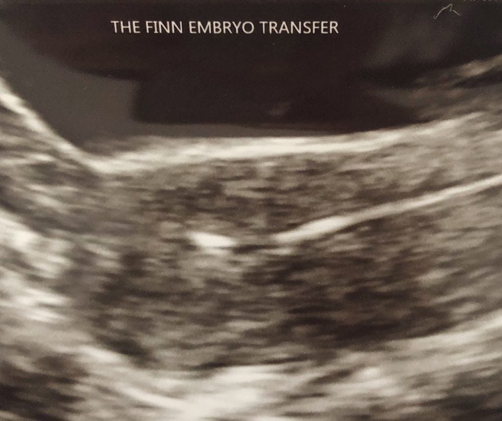 embryo transfer