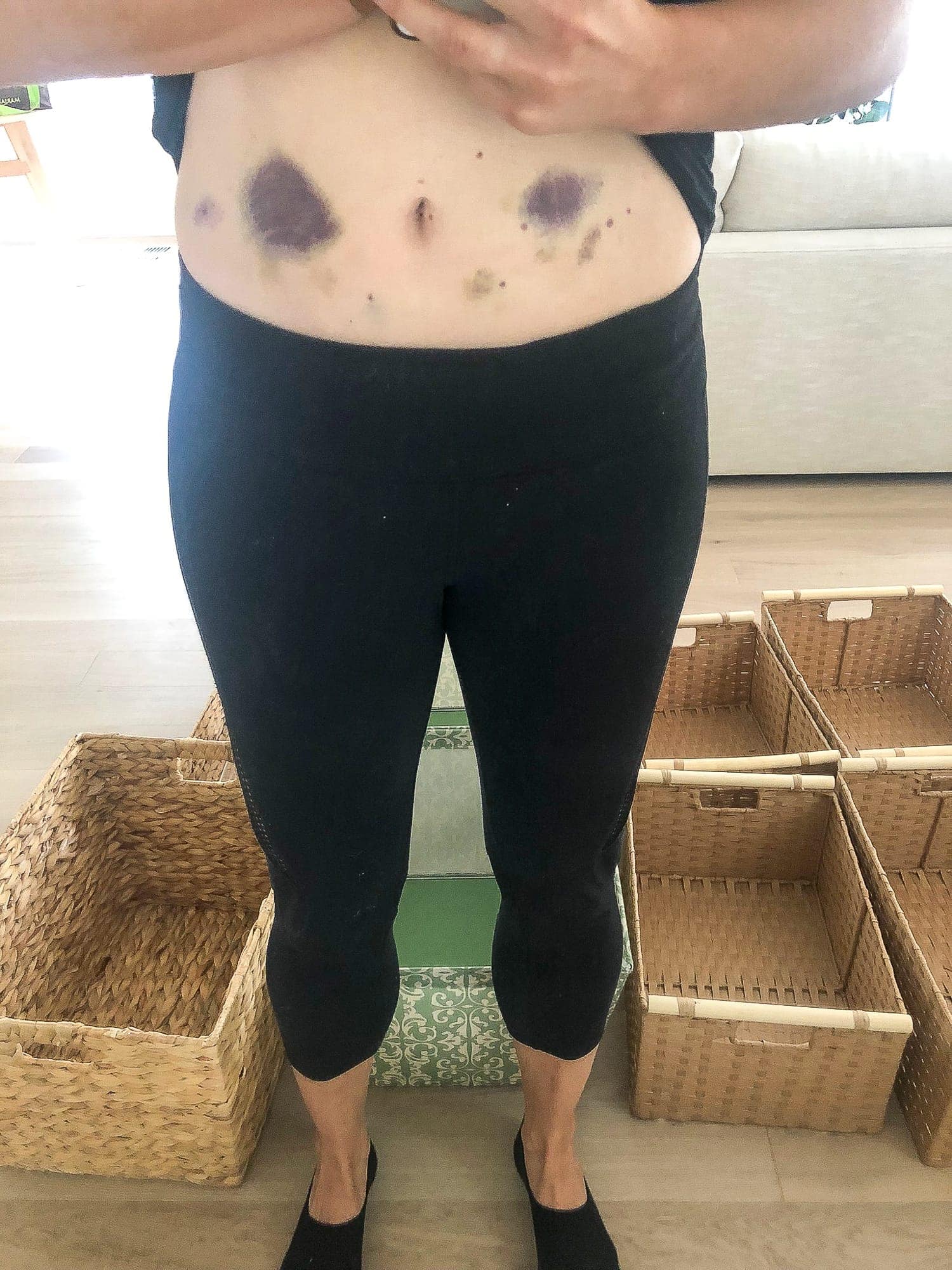 Bruises from Lovenox shots